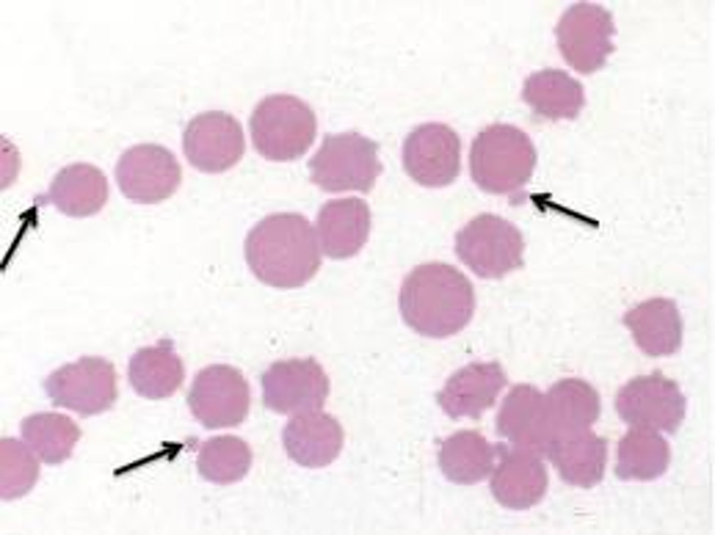 <p>Aggregation of cross-linked haemoglobin producing Heinz bodies - this can lead to haemolysis and anaemia </p>