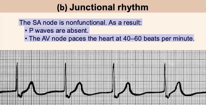 <p>The SA node is nonfunctional. As a result:</p><p>• P waves are absent.</p><p>• The AV node paces the heart at 40–60 beats per minute.</p>
