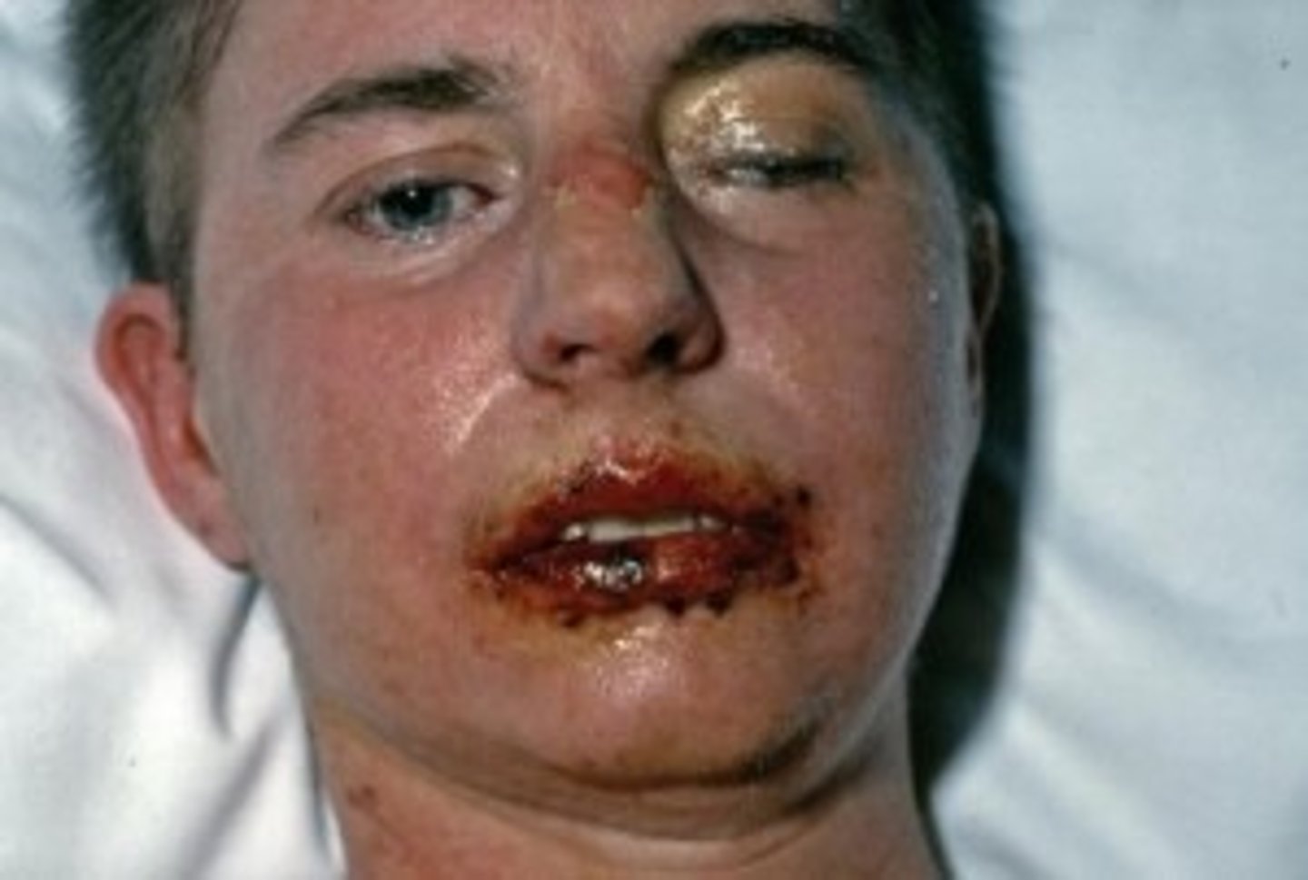 <p>- 2-7 cases per 1 mil people</p><p>- more common in immunosuppressed</p><p>- females &gt; males</p>