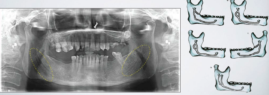 <p>if a patient has a bifid inferior alveolar nerve/canal, the nerve block might fail. how can you correct this?</p>