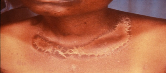 <p>A patient presents with a patch of rough dry skin. What is this called, and what is this caused by?</p>