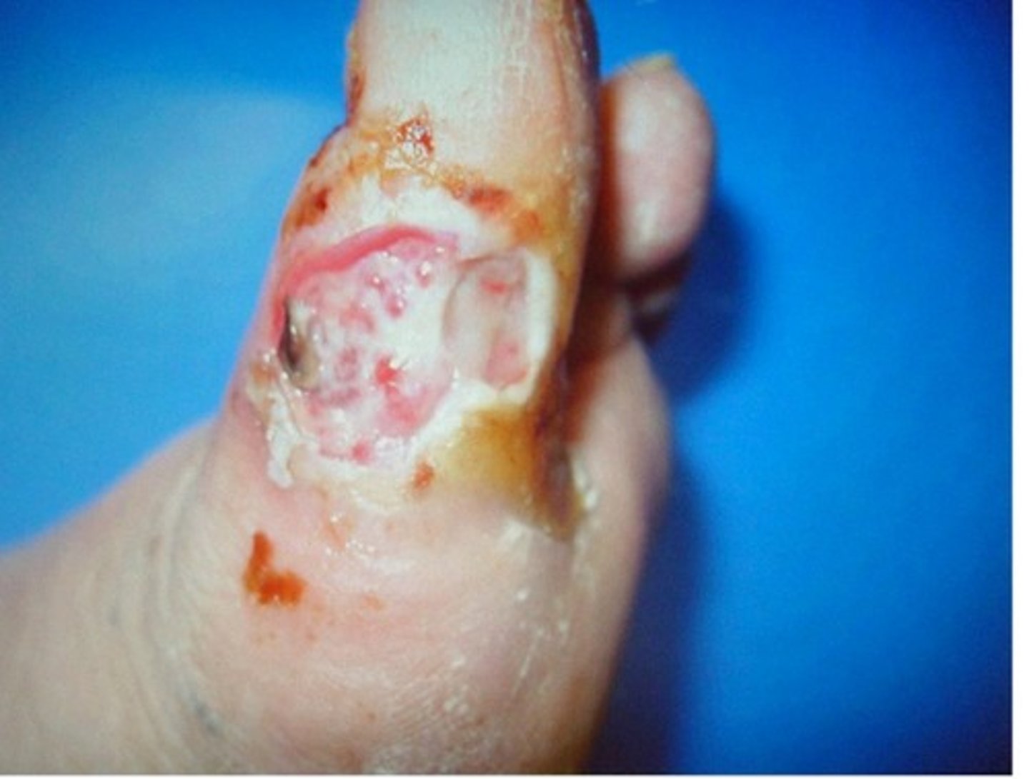 <p>Wagner grade ___ diabetic wound; superficial or partial thickness ulcer, does NOT involve subcutaneous tissue</p><p>Treatment = local wound care, protect from maceration, foot protection</p>