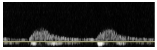 <p>if bilateral, where is the disease?</p>