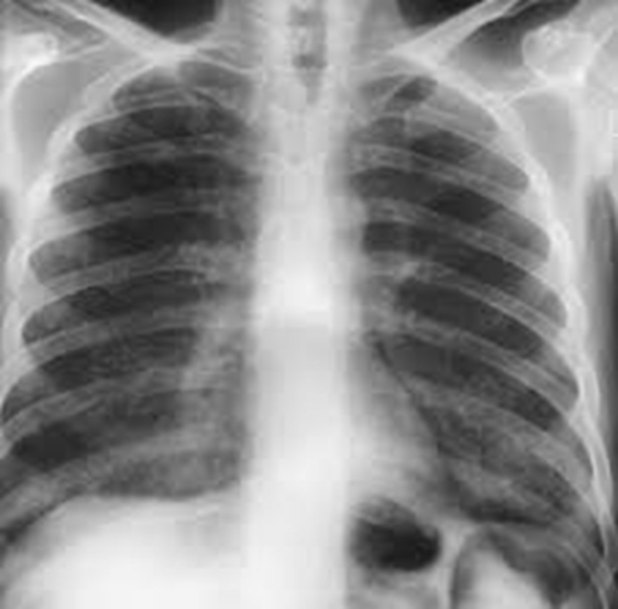 <p>notice how the interstitial markings are increased &amp; look like prominent "scratch" marks throughout both upper lung fields</p><p>- heart borders are reasonably well maintained</p>
