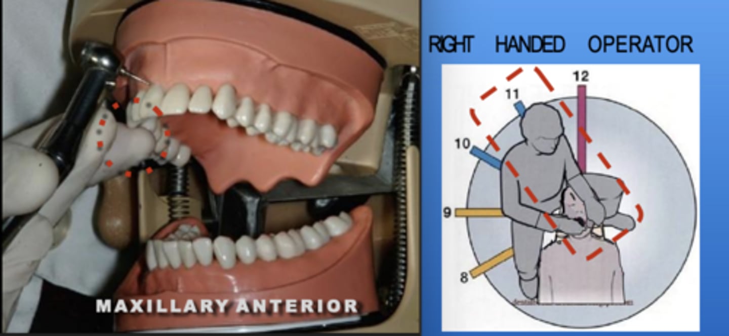 <p>Zone: 11</p><p>Vision: Direct</p><p>Patient's Head: Center</p><p>Fulcrum: Max Right Premolar (O)</p>