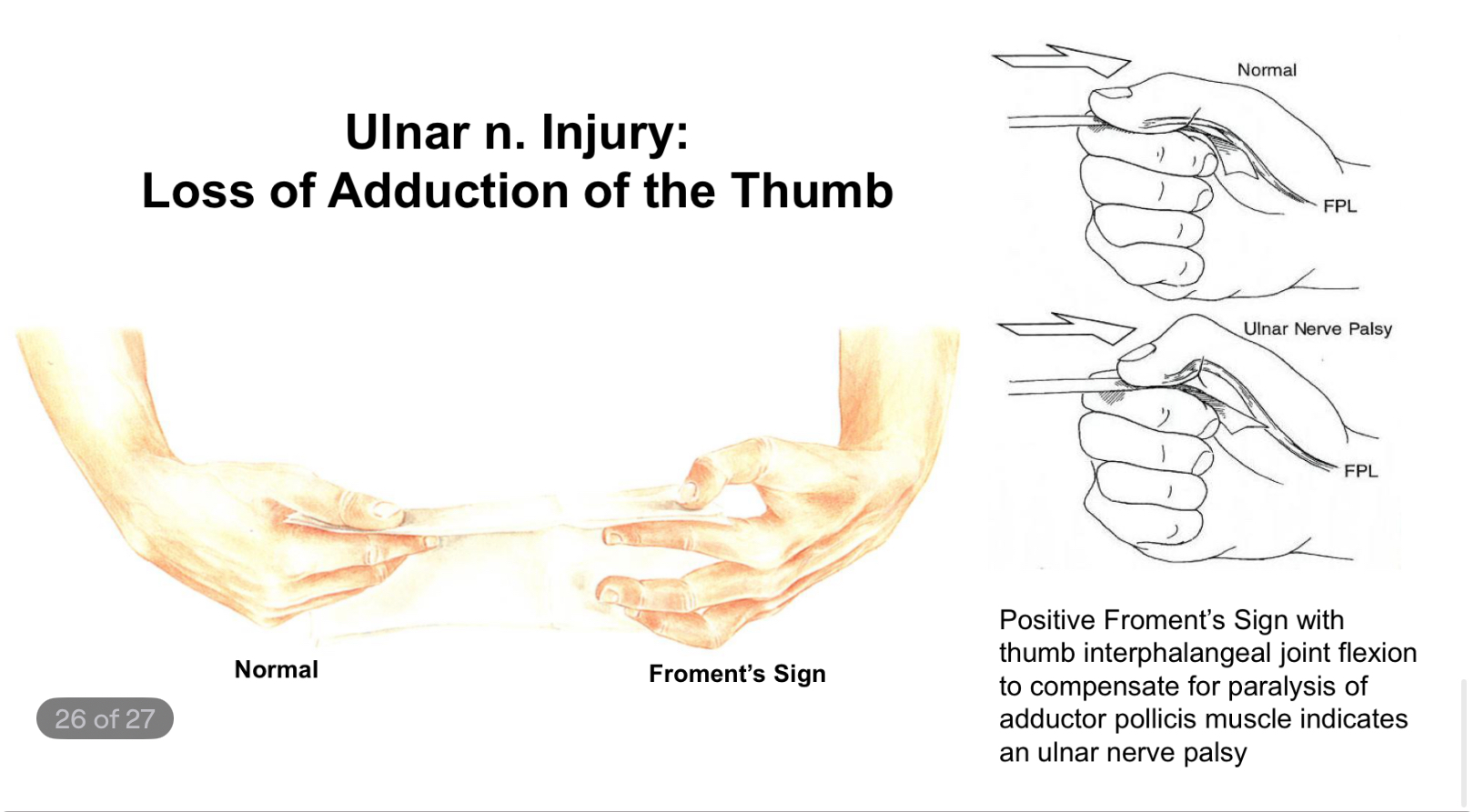 <p>Positive Froment’s Sign with thumb interphalangeal joint flexion to compensate for paralysis of adductor pollicis muscle</p>