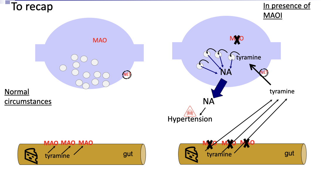 <p>Most noradrenaline released will be recycled and end up repackaged into vesicles ready to be released again</p><p>the amount recycled can be increased further by inhibniting the enzyme monoamine oxidase so that more gets repackaged into vesifles rather than being destroyed.</p><p>Monoamine oxidase inhibitor drugs (MAOIs) have been used to treat some forms of depression (less common these days)</p><p>One of the reasons they are not used is because patients taking MAOIs have to avoid certein foods like cheese, pickled herring, and chianti wine that contain large amounts of tyramine </p><p>If they do eat cheese containing tyramine, it can lead to a severe increase in b.p., a so-called hypertensive crisis, because, as well as beingfound in nerves, MAO is also found in cells of the gut wall where it is responsible for nreaking down dietary tyramine. Normally when we eat cheese, very little tyramine actually reaches our bloodstream, but when you take a MAOI, lots reaches the bloodstream and eventually reaches sympathetic nerves</p><p>Tyramine is an indirectly acting sympathomimetic drug - itgets taken up into sympathetic nerve vericosities (through NET) and into the synaptic vesicles (through VMAT) ewhere is displaces noradrenaline out of the vesicle and into cell cytoplastm.</p><p>Normally, this would be destroyed by MAO, but the enzyme is ingibited so the concentration of noradrenaline in the cytoplas,m builds up until it eventually leaks out of the nerve, activating reeptors, leading to hypertension. </p>