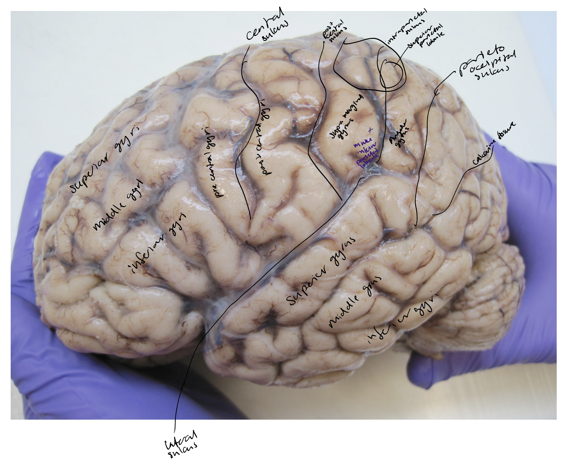 <ul><li><p>The longitudinal fissure</p></li><li><p>Cerebral hemispheres</p></li><li><p>Central sulcus</p></li><li><p>Parietooccipital sulcus</p></li><li><p>Frontal, parietal and occipital lobes of the brain</p></li><li><p>The precentral and postcentral gyri</p></li><li><p>The central sulcus</p></li><li><p>Lateral sulcus</p></li><li><p>Parietooccipital sulcus</p></li><li><p>Precentral and postcentral gyri &amp; sulci</p></li><li><p>Frontal sulci &amp; gyri</p></li><li><p>Temporal sulci &amp; gyri</p></li><li><p>Intraparietal sulcus</p></li><li><p>Superior parietal lobule</p></li><li><p><strong>Supramarginal gyri</strong></p></li><li><p><strong>Angular gyri</strong></p></li></ul><p></p>