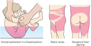 <p>symmetrical burns, no splash marks, patterned burns, doughnut sign</p>