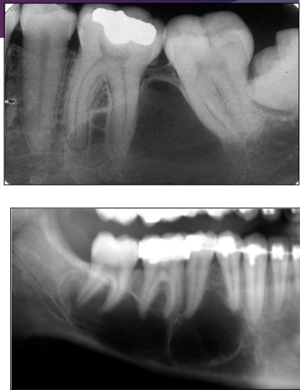 <p>Are teeth associated with Traumatic Bone Cyst (TBC) typically vital or non-vital</p>