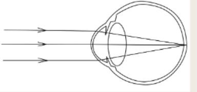 <p>absence of ametropia: emmetropia</p>