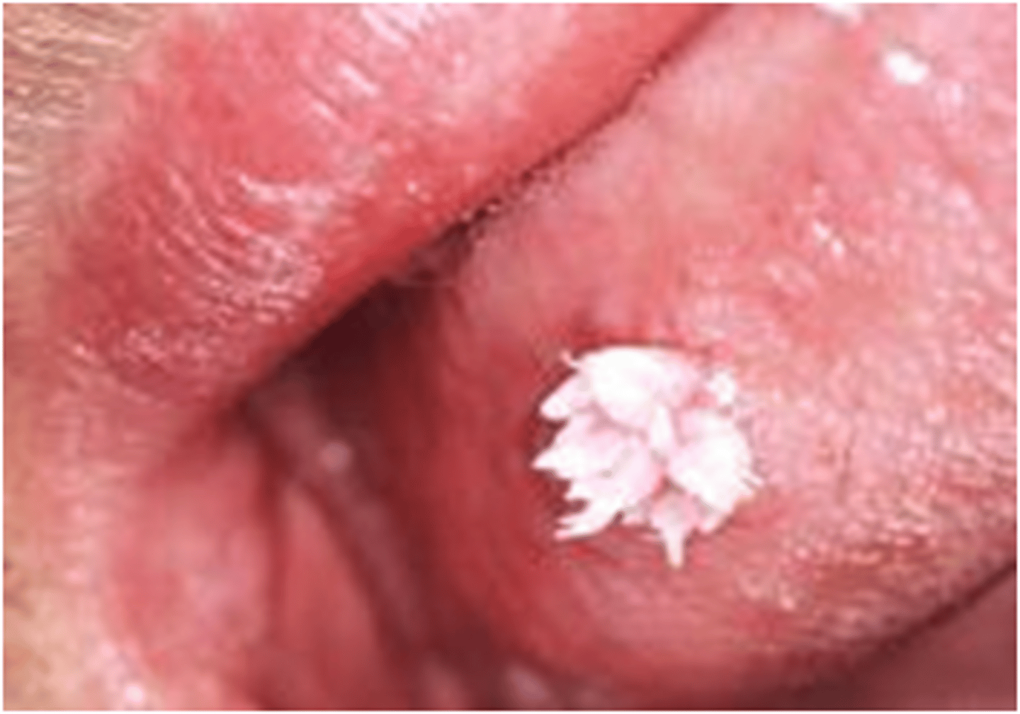 <p>cause warts on skin, genitals, anus, mouth or throat</p>