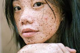 <p>What type of skin lesion is this? Give an example.</p>
