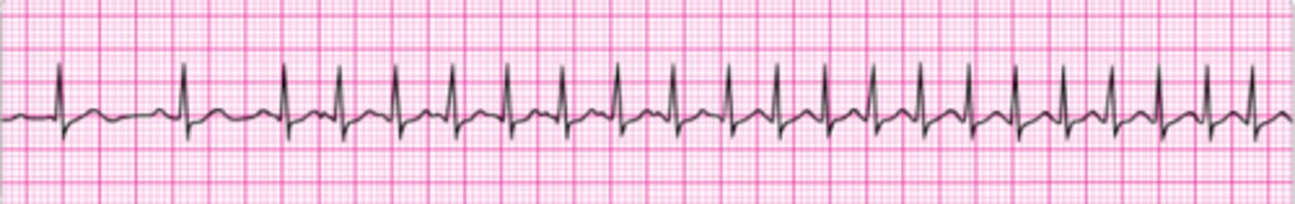 <p>A 45-year-old woman with a history of palpitations develops light-headedness and palpitations. She has received adenosine 6 mg IV for the rhythm shown above without conversion of the rhythm. She is now extremely apprehensive. Blood pressure is 108/70 mm Hg. What is the next appropriate intervention?</p><p>1. Repeat adenosine 3 mg IV.</p><p>2. Perform immediate unsynchronized cardioversion.</p><p>3. Sedate and perform synchronized cardioversion.</p><p>4. Repeat adenosine 12 mg IV .</p><p>5. Perform vagal maneuvers and repeat adenosine 6 mg IV.</p>
