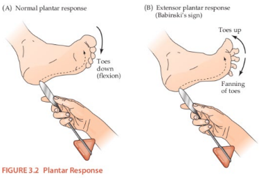 <p><strong>Special Reflexes</strong></p><p>-_________ → a normal reflex in infants, shows injury to the brain or spine </p><p>-Hoffman</p><p>-Ankle clonus → _________ of the ankle as a nonspecific marker of injury in the motor center </p>