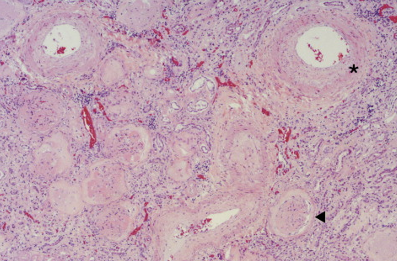 <p>What is shown at the asterisk &amp; triangle of this histology of nephrosclerosis?</p>