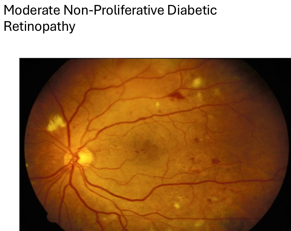 <ul><li><p>microaneurysms</p></li><li><p><strong>dot/blot</strong>/flame hemes</p><ul><li><p>dot/blot &gt; flame and CWS</p></li></ul></li><li><p>roth spots</p></li><li><p>capillary non-perfusion/dropout</p></li><li><p>cotton wool spots</p></li><li><p>exudates</p></li><li><p>venous beading</p></li><li><p>omega/vascular loops</p></li><li><p>IRMA</p></li></ul><p></p>