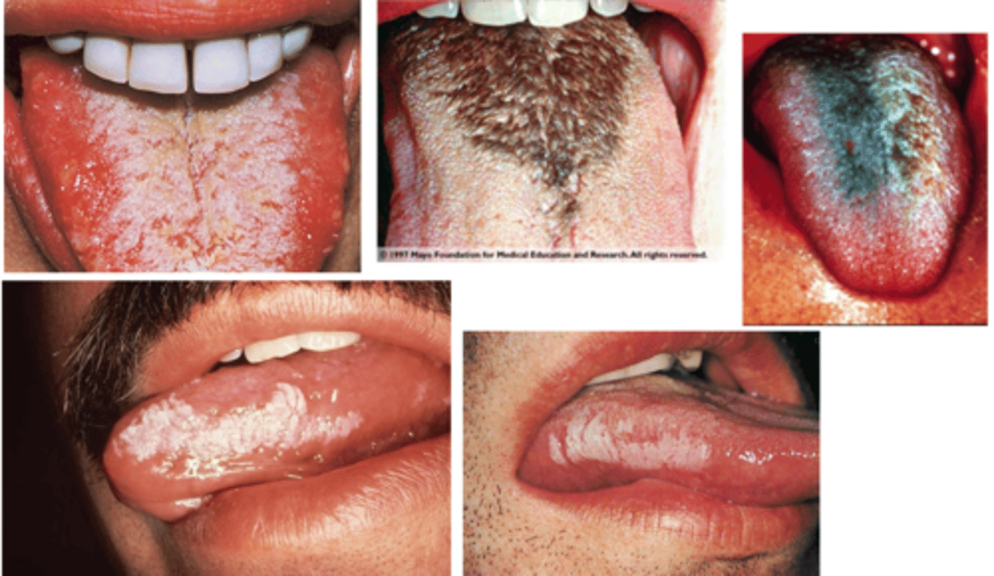 <p>is a white, non-removable lesion of the lateral tongue caused by Epstein Barr Virus.</p>