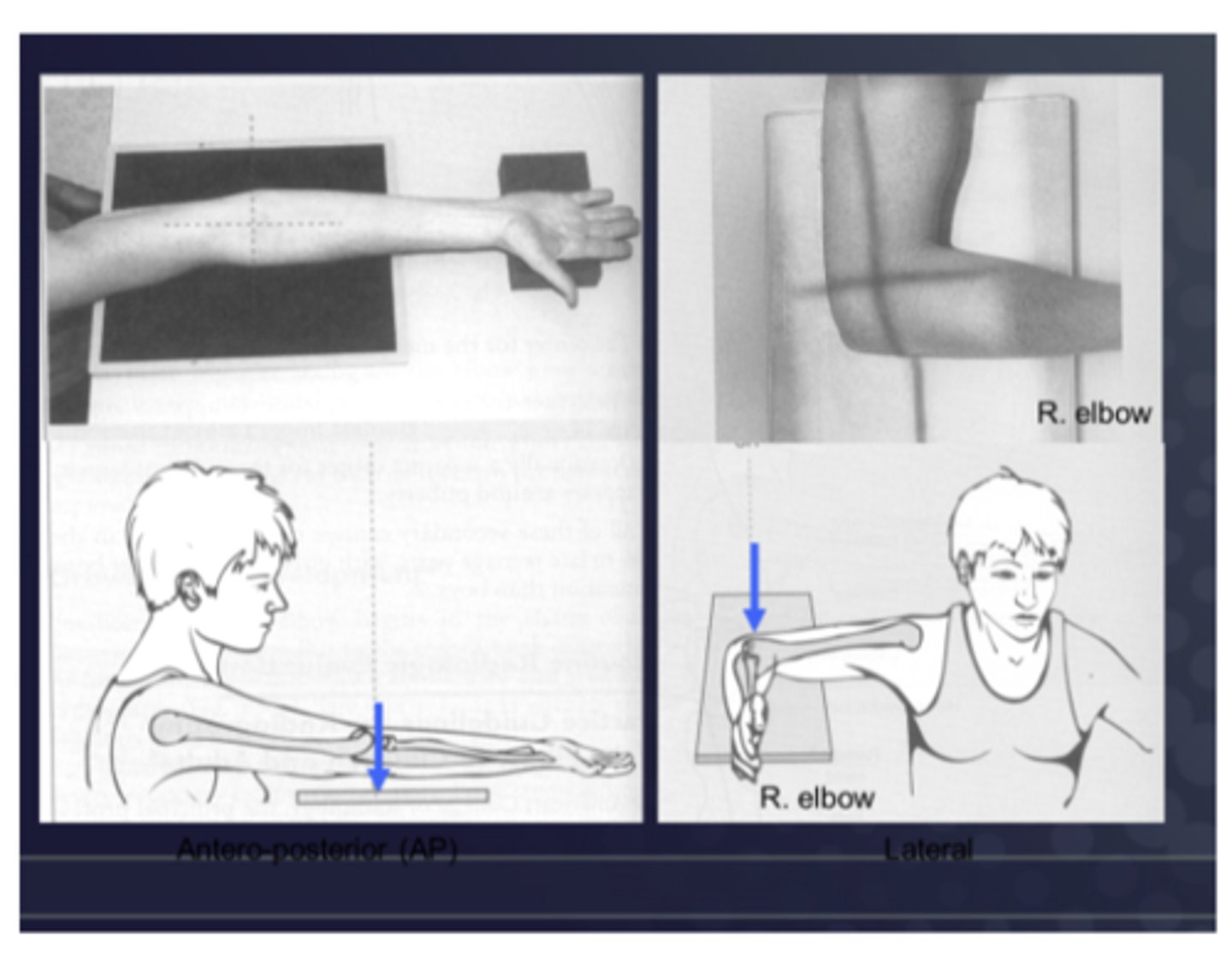 <p>Enter ANTERIORLY &amp; exit POSTERIORLY</p>