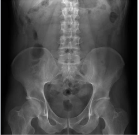 <p>Identify Psoas muscles, lumbar vertebrae, femur, illiacus</p>