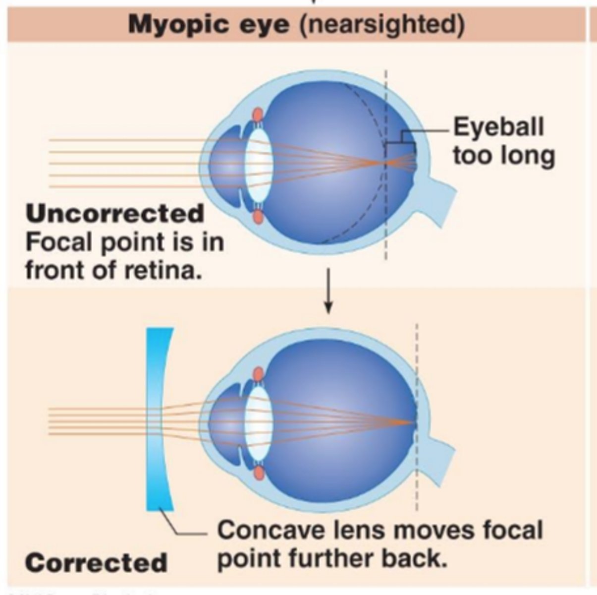 <p>Eyeball too long, causes myopia (nearsightedness), focal point is in front of the retina; <strong>concave </strong>lens</p>