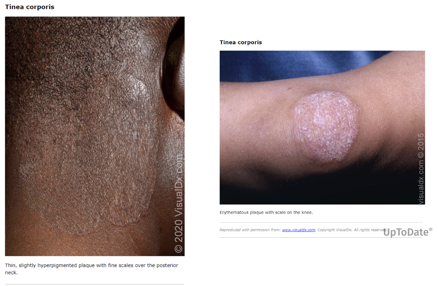 <p>Which fungi are transmitted by <strong><span>infected skin scales (human-to-human), animals (pets) and contaminated surfaces </span></strong><span>and causes </span><strong><span>itching, scaling skin patches</span></strong><span> that become inflamed and weep?</span></p><ul><li><p>over 20 species of <strong>tineas</strong></p></li></ul>
