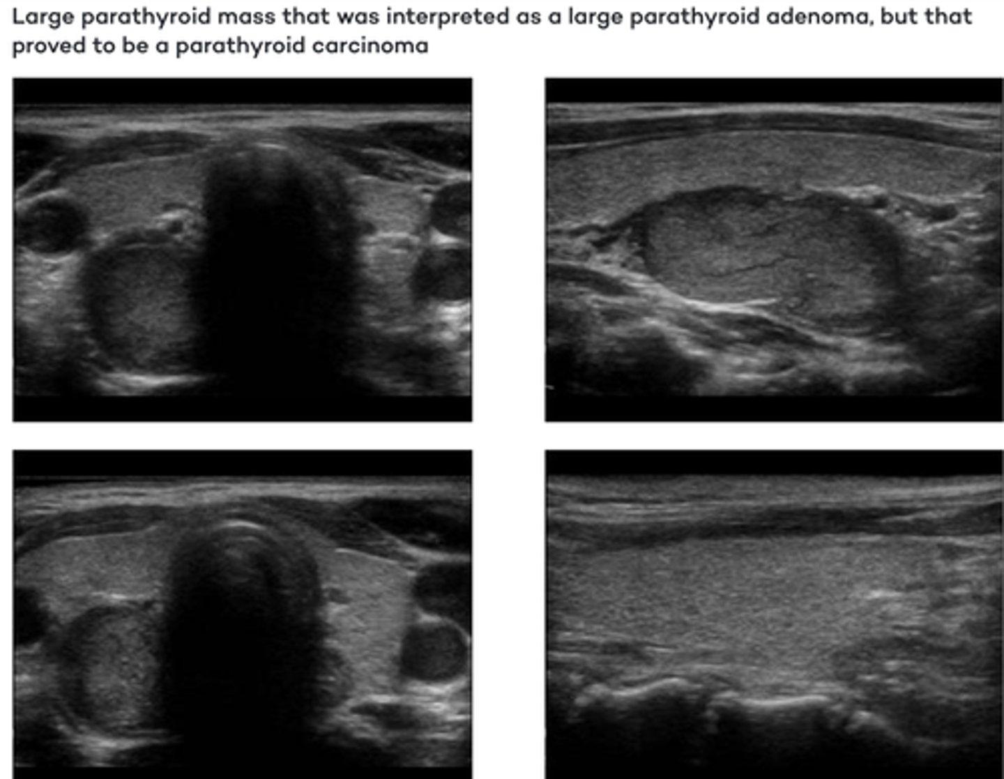 <p>Etiology</p><p>-Epithelial neoplasm</p><p>-Slow-growing</p><p>-Tend to infiltrate surrounding tissues</p><p>Clinical findings</p><p>-Hypercalcemia</p><p>-Elevated parathormone level</p><p>-Firm palpable neck mass</p><p>Sonographic findings</p><p>-Hypoechoic lobulated mass</p><p>-Round or oval in shape</p><p>-Attenuation of sound (dense)</p><p>-Hypervascular </p>