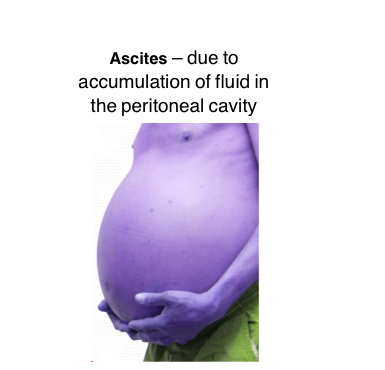 <p>Ascites</p>