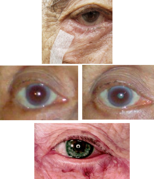 <p>What type of eyelid position is managed <em>temporarily</em> by:</p><ul><li><p><strong>Protect the ocular surface</strong>:</p><ul><li><p>Lubrication</p></li><li><p>Bandage CL</p></li><li><p>Lash epilation</p></li><li><p>Lid taping</p></li><li><p>Botox for blepharospasm</p></li><li><p>Quickert sutures</p><ul><li><p>Tighten lower lid retractors and every lid</p></li></ul></li></ul></li></ul><p></p>