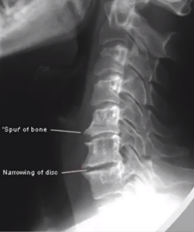 <p>(TOP) BONE SPUR, (BOTTOM) NARROWING OF DISC</p>