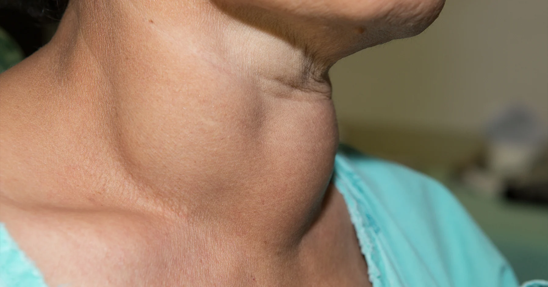 <ol><li><p>goiter is chronic thyroid enlargement</p></li><li><p>often caused by a low diet in iodine (common in regions with low iodine in the soil) but also from a number of autoimmune disease, nodules, pregnancy, or medications</p></li></ol><p></p>