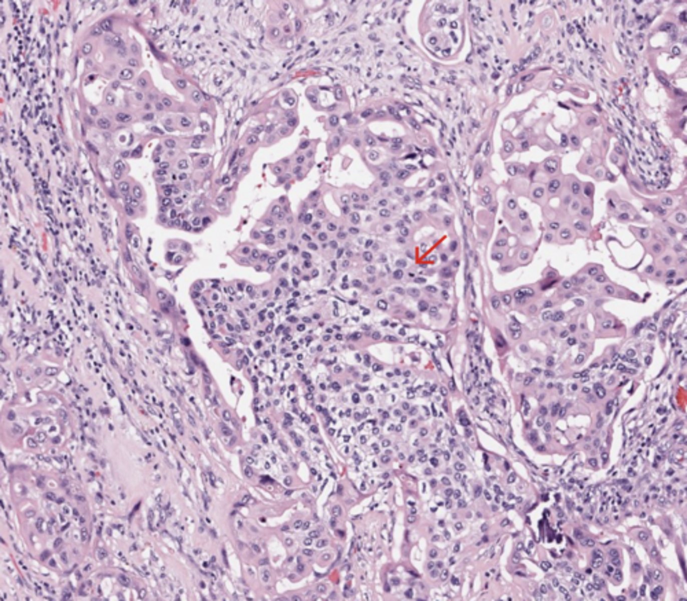 <p>Urothelial tract</p>