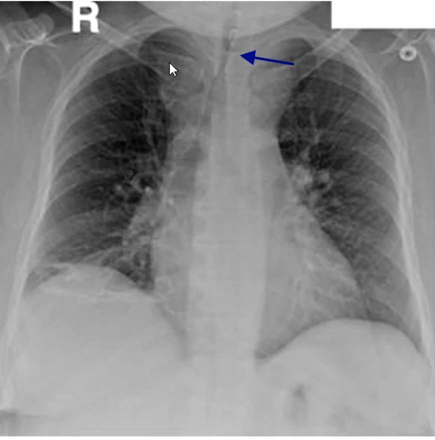 <p>patient presents with the following radiograph. What is the diagnosis?</p>