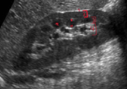 <p>What are the names of the areas labeled with a star and heart on a medullary pyramid? </p>