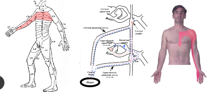 <p>-pain from heart usually moderate to severe and is perceived as referred pain</p><p>-areas in which pain felt correlates (more or less) with the dermatomes innervated by sensory neurons whose cell bodies are in the same dorsal root ganglia as those of the heart (dorsal root ganglia from T1 through T4)</p><p>-cardiac pain typically felt in left arm, shoulder, or sternum</p><p>-women somewhat more likely than men to experience some of the other common symptoms, particularly shortness of breath, nausea/vomiting, and back or jaw pain as opposed to chest pain</p><p>-not known why pain may only be present in part of a dermatome</p>