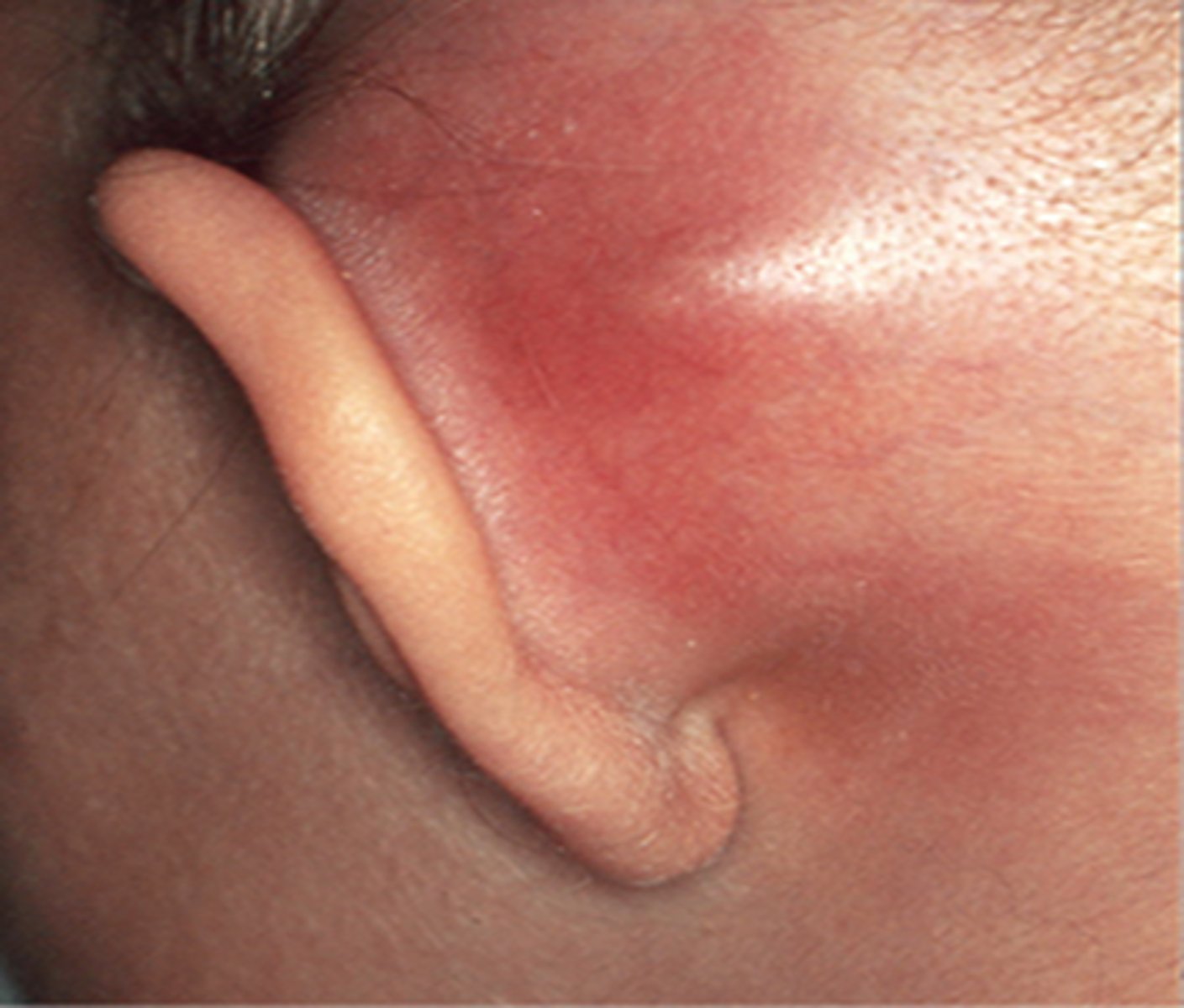 <p>Typical s/sx of OM PLUS-<br><br>Postauricular tenderness, erythema, and edema<br><br>Protrusion of the auricle<br><br>Otalgia<br><br>Fever<br><br>Narrowing of EAC</p>