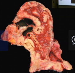 <ul><li><p>Strongly associated with asbestos exposure (80-90%)</p></li><li><p>Has a long latent period of 25 to 40 years</p></li><li><p>Preceded by pleural fibrosis and plaque formation</p></li></ul><p></p>