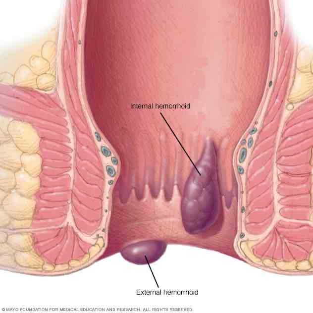 <p>Swollen or twisted veins either outside or just inside the anus</p>