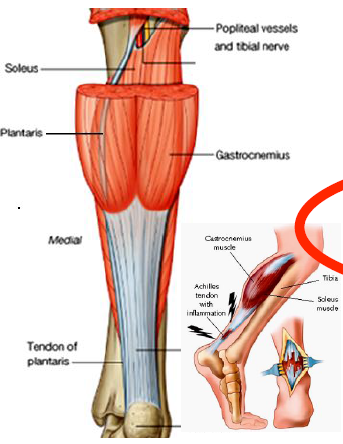 disables gastroc and soleus, cannot plantarflex