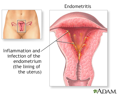 <p><strong>Uterine Infection (Endometritis)</strong></p>