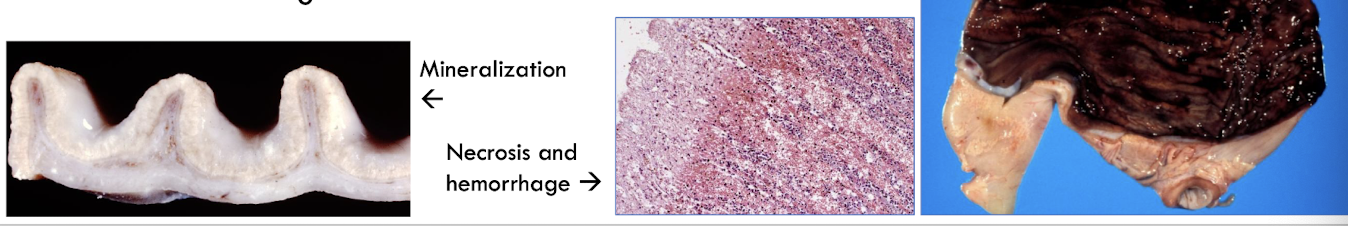 <p>mineralization of the glands, vessels (endothelium), &amp; lamina propria of the gastric mucosa w/ thrombosis, hemorrhage, necrosis ± ulceration </p>