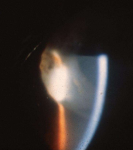 <p>you look thru a slit microscope at the eye and see this, what is it?</p>