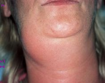 <p><strong>Risk Factors, Symptoms, and Treatment for Sialolithiasis/Adenitis </strong></p><p>-_________, diuretics, anticholinergics, trauma, hx of gout or nephrolithiasis, ________, and chronic periodontal disease </p><p>-______ and swelling in the involved gland. Usually aggravated by _______. May palpate or see ____ in duct</p><p>-_______, moist heat, gland and duct _________, such on ____/_____ candies (1st line): sialogogues, analgesics, and antibiotics if concern for infection</p>