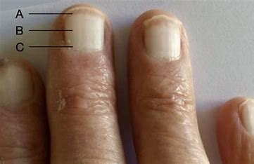 <p>¾ of nail is white with a narrow pink band</p><ul><li><p>occurs with liver failure, renal failure, DM, CHF</p></li></ul>