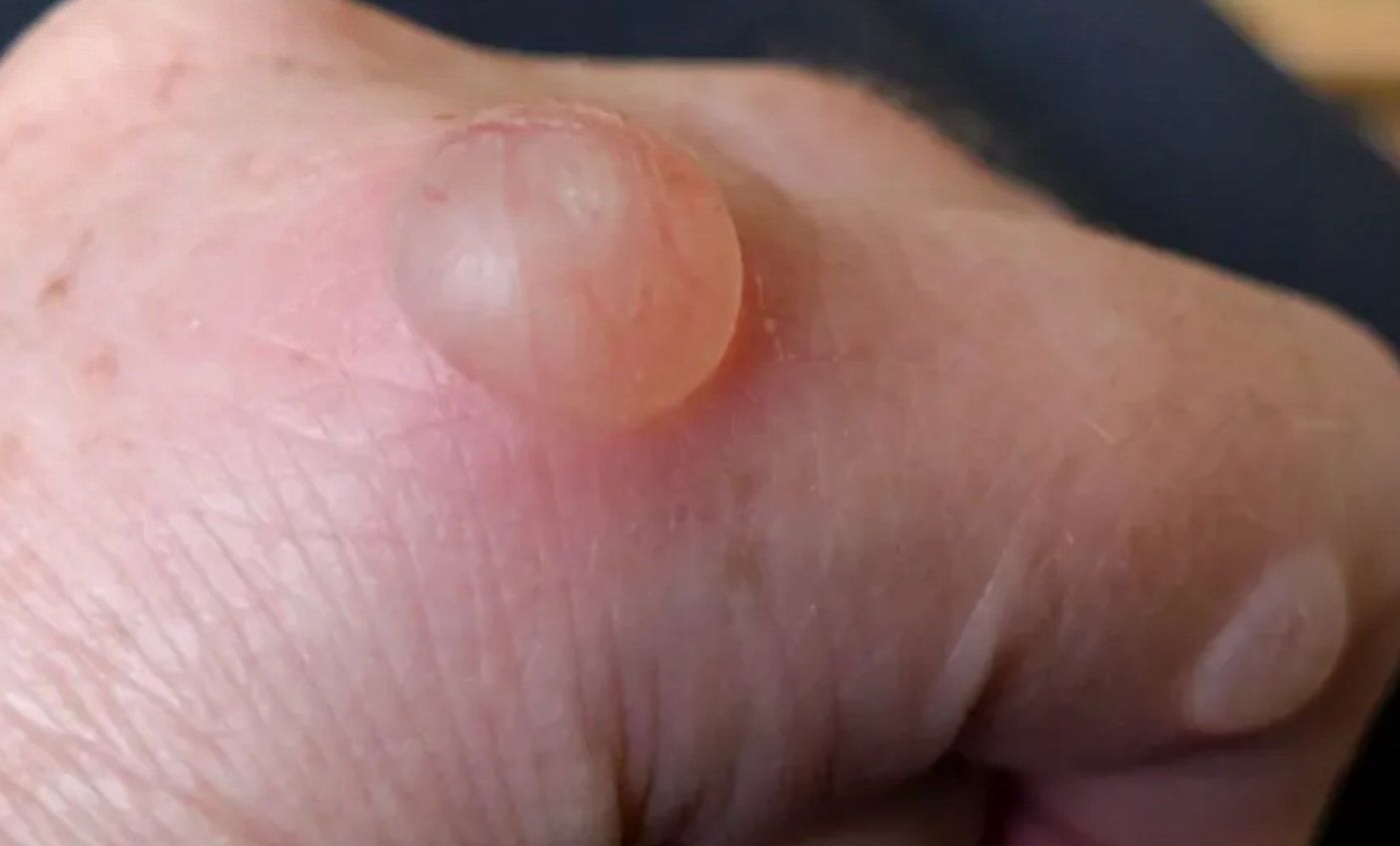 <p>Vesicle</p>