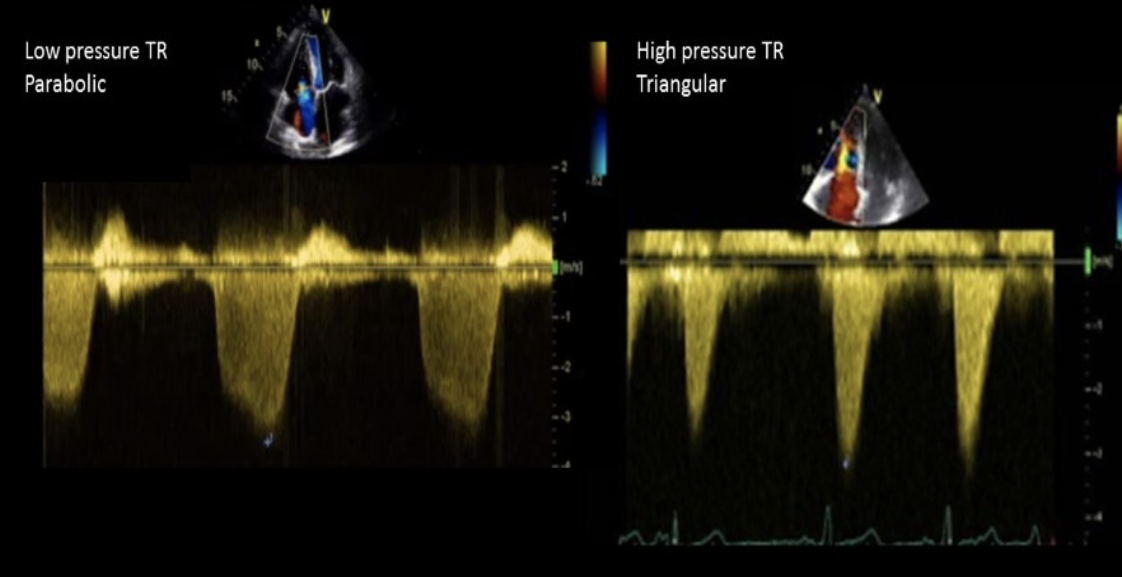 <p>Doppler evaluation of severe TR demonstrates? </p>