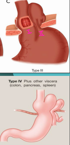 <p><strong>Hiatal Hernia: Type III and IV</strong></p><p>-Type III → Mixed Hernia</p><ul><li><p>Combo of type I and II</p></li><li><p>Occur in conjunction with other diseases like ____, peptic ulcer, cholecystitis </p></li></ul><p>-Type IV</p><ul><li><p>Aggravated form of Type ___</p></li><li><p>Includes herniation of other abdominal ________ (intestine, pancreas, spleen)</p></li></ul><p></p>