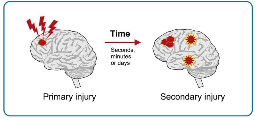 <p>Tijd</p><p><u>Primaire letsels</u></p><ul><li><p>onmiddellijk na inwerking van mechanische kracht van buitenaf op schedel &amp; brein</p></li><li><p>vooral thv frontale &amp; temporale kwabben </p></li></ul><p><u>Secundaire letsels</u></p><ul><li><p>meestal complicaties van primaire</p></li><li><p>ontstaan in uren tot dagen na THL</p></li><li><p>ontstaan geleidelijk</p></li></ul><p>Individuele verschillen: verschillende combinaties van letsels kunnen voorkomen</p>