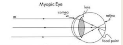 <p>myopic eye </p>