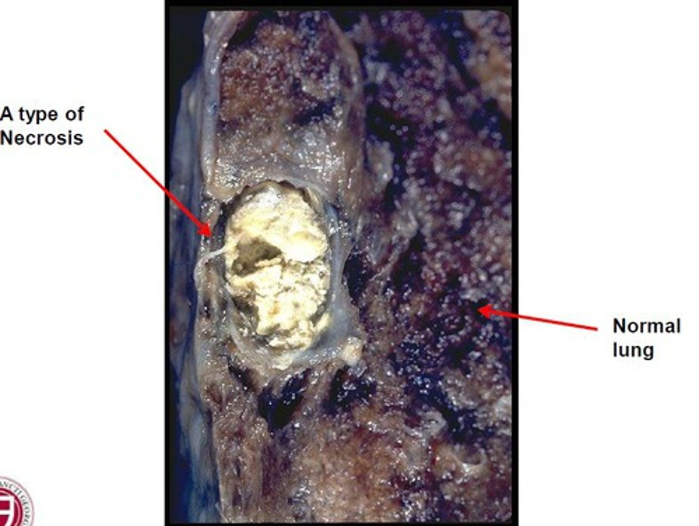 <p>cheeselike, friable white appearance of the area of necrosis</p>